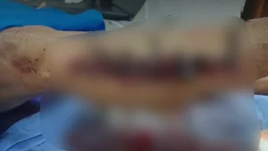 Salud conforma equipo de auditoría médica para indagar atención al paciente suturado con cintillo