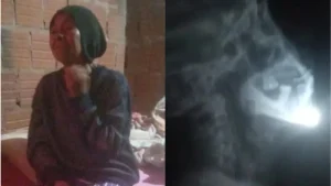 PJC: Piden auxilio para operar a una mujer con un hueso en la garganta